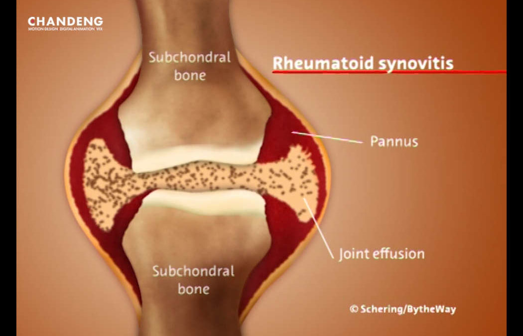 Film Rheumatoid Synovitis